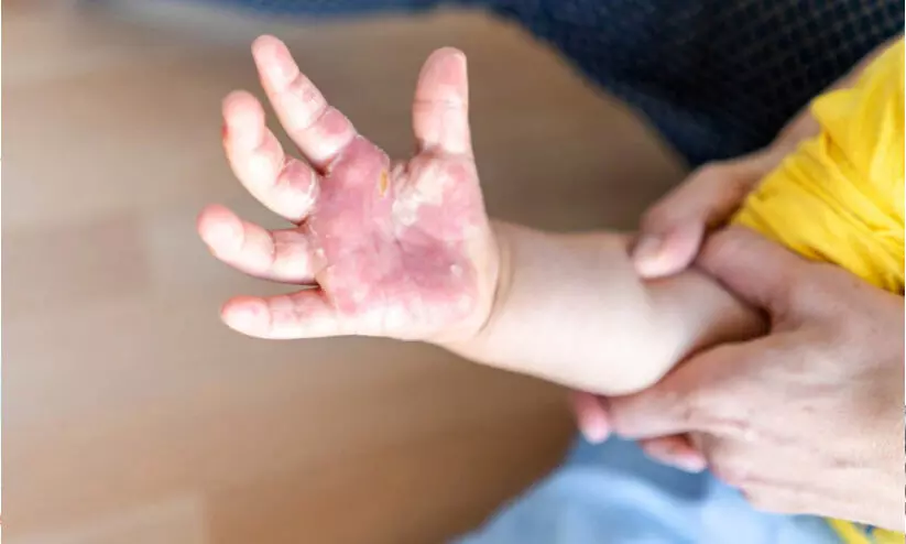 അവണൂരിൽ തക്കാളിപ്പനി പടരുന്നു