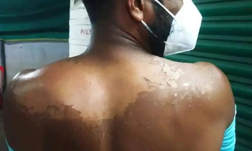 എന്തൊരു ചൂട്! സൂര്യാഘാതമേറ്റാല്‍ എന്തുചെയ്യണം? ശ്രദ്ധിക്കാം ഈ കാര്യങ്ങൾ...