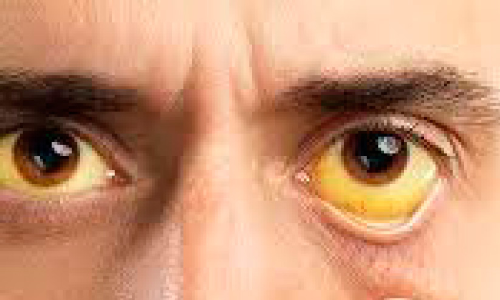 ആശങ്ക പരത്തി മഞ്ഞപ്പിത്തം