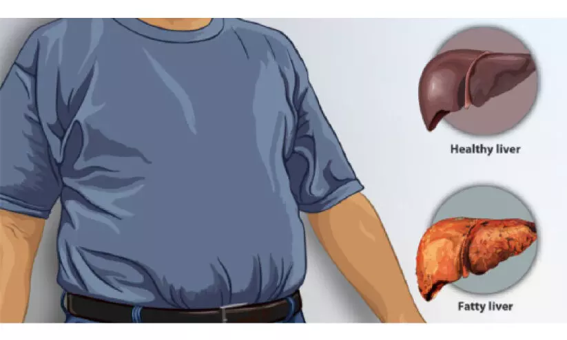 ഫാറ്റി ലിവര്‍ ജീവിതശൈലികൊണ്ട് കീഴ്‌പെടുത്താം