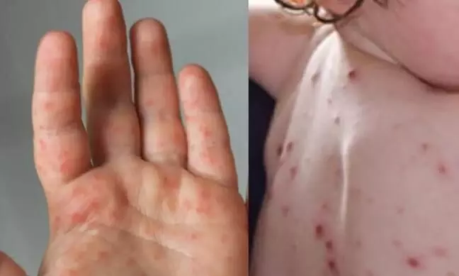 ജില്ലയിൽ കുട്ടികൾക്കിടയിൽ തക്കാളിപ്പനി പടരുന്നു; അഞ്ച് കുട്ടികൾക്ക് രോഗബാധ സ്ഥിരീകരിച്ചു ജില്ലയിൽ കുട്ടികൾക്കിടയിൽ തക്കാളിപ്പനി പടരുന്നു; അഞ്ച് കുട്ടികൾക്ക് രോഗബാധ സ്ഥിരീകരിച്ചു