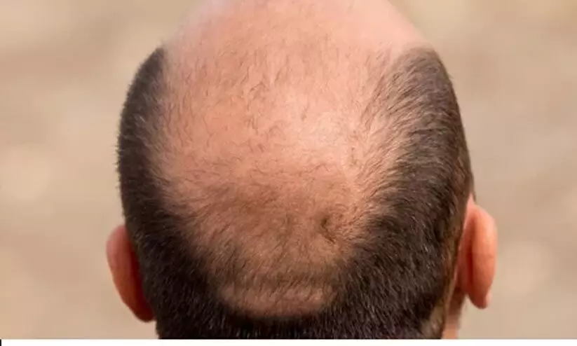 കഷണ്ടിയെന്ന് വിളിക്കുന്നത് ലൈംഗിക അധിക്ഷേപമായി കണക്കാക്കാമെന്ന് യു.കെ ട്രിബ്യൂണൽ