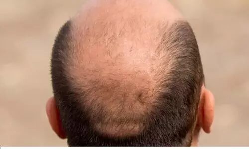 കഷണ്ടിയെന്ന് വിളിക്കുന്നത് ലൈംഗിക അധിക്ഷേപമായി കണക്കാക്കാമെന്ന് യു.കെ ട്രിബ്യൂണൽ