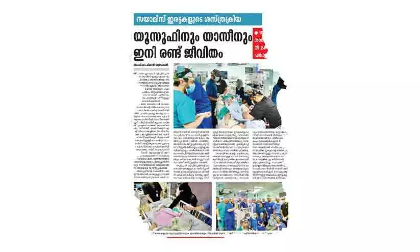 യമനി സയാമീസ് ഇരട്ടകളിലൊരാൾ മരിച്ചു