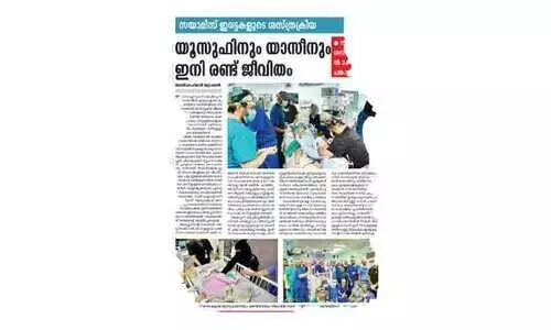 യമനി സയാമീസ് ഇരട്ടകളിലൊരാൾ മരിച്ചു