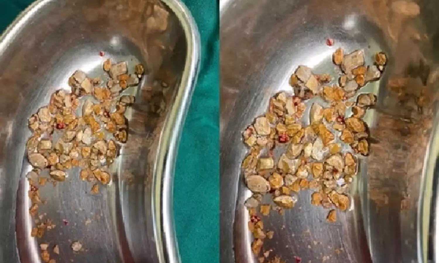 മധ്യവയസ്കന്‍റെ വൃക്കയിൽനിന്ന് നീക്കിയത് 206 കല്ലുകൾ