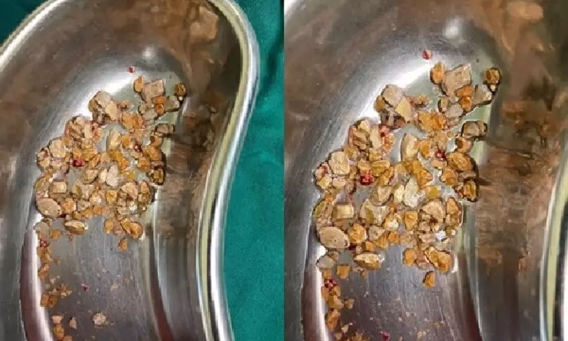 മധ്യവയസ്കന്റെ വൃക്കയിൽനിന്ന് നീക്കിയത് 206 കല്ലുകൾ മധ്യവയസ്കന്റെ വൃക്കയിൽനിന്ന് നീക്കിയത് 206 കല്ലുകൾ