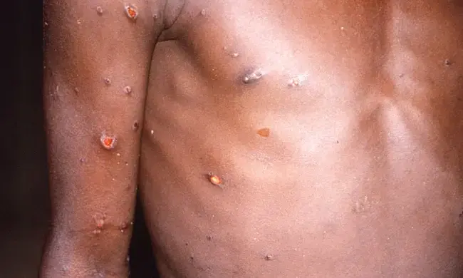 യു.എസിൽ ആദ്യ കുരങ്ങുപനി കേസ് സ്ഥിരീകരിച്ചു; കാനഡയി​ലേക്ക് യാത്ര ചെയ്തയാൾക്ക് രോഗം