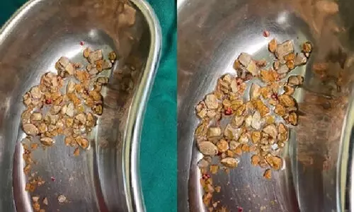 മധ്യവയസ്കന്‍റെ വൃക്കയിൽനിന്ന് നീക്കിയത് 206 കല്ലുകൾ