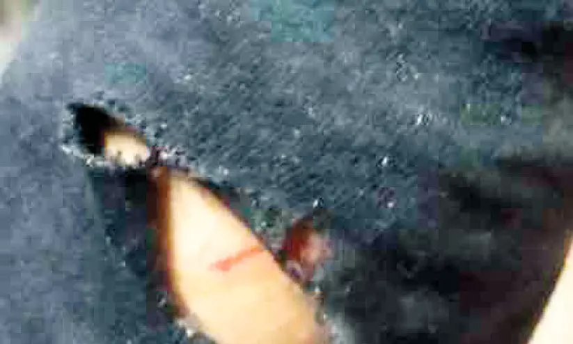 തെരുവുനായുടെ ആക്രമണത്തിൽ വിദ്യാർഥിക്ക് പരിക്ക്