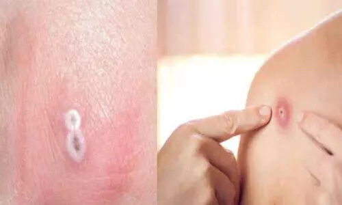 കു​ര​ങ്ങു​പ​നി​: പ്ര​തി​രോ​ധ ന​ട​പ​ടി​യു​മാ​യി ആ​രോ​ഗ്യ വ​കു​പ്പു​ക​ൾ