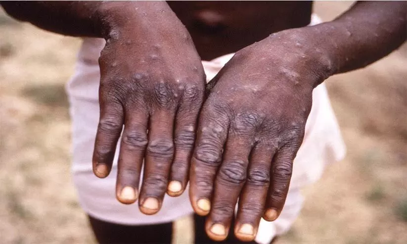 കുരങ്ങുപനി: നിരീക്ഷണം ശക്തമാക്കി ആരോഗ്യ മന്ത്രാലയം കുരങ്ങുപനി: നിരീക്ഷണം ശക്തമാക്കി ആരോഗ്യ മന്ത്രാലയം