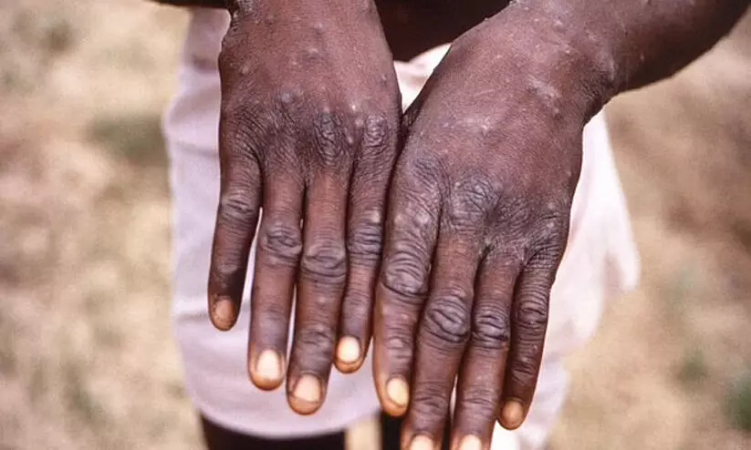 കുരങ്ങുപനിക്ക് ക്വാറന്റൈൻ നിർബന്ധമാക്കുന്ന ആദ്യ രാജ്യമായി ബെൽജിയം കുരങ്ങുപനിക്ക് ക്വാറന്റൈൻ നിർബന്ധമാക്കുന്ന ആദ്യ രാജ്യമായി ബെൽജിയം