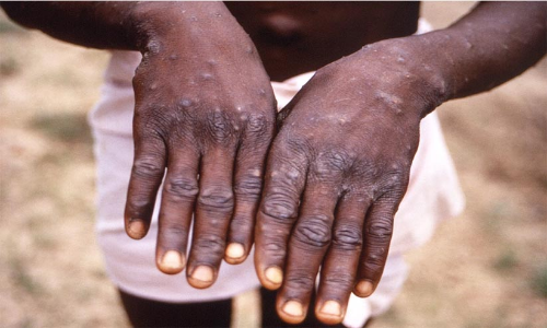 കുരങ്ങുപനി: നിരീക്ഷണം ശക്​തമാക്കി​ ആരോഗ്യ മന്ത്രാലയം