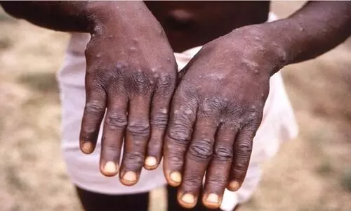 കുരങ്ങുപനി: നിരീക്ഷണം ശക്​തമാക്കി​ ആരോഗ്യ മന്ത്രാലയം