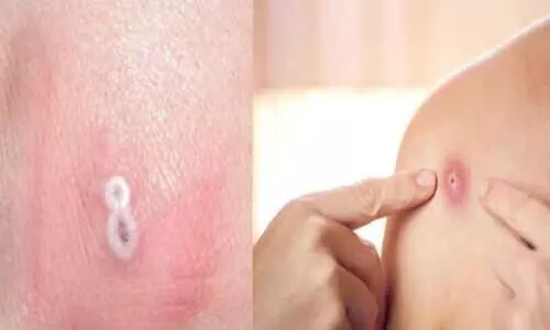 ഖത്തറിൽ കുരങ്ങുപനി റിപ്പോർട്ട് ചെയ്തിട്ടില്ലെന്ന് ആരോഗ്യ മന്ത്രാലയം