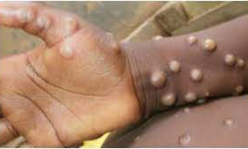 കുവൈത്തിൽ കുരങ്ങുപനി റിപ്പോർട്ട് ചെയ്തിട്ടില്ലെന്ന് ആരോഗ്യ മന്ത്രാലയം