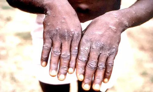 രാജ്യത്ത് കുരങ്ങുപനി റിപ്പോർട്ട് ചെയ്തിട്ടില്ല - ആരോഗ്യമന്ത്രാലയം