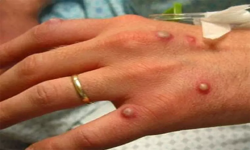 കുരങ്ങുപനി: യു.എ.ഇയിൽ മൂന്ന് കേസുകൾകൂടി കുരങ്ങുപനി: യു.എ.ഇയിൽ മൂന്ന് കേസുകൾകൂടി