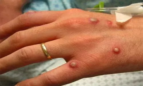 കുരങ്ങുപനി: യു.എ.ഇയിൽ മൂന്ന് കേസുകൾകൂടി