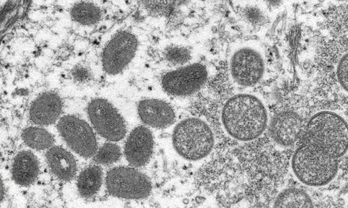 മങ്കിപോക്സ് ആഗോള മഹാമാരിക്ക് കാരണമാകില്ലെന്നാവർത്തിച്ച് ലോകാരോഗ്യ സംഘടന