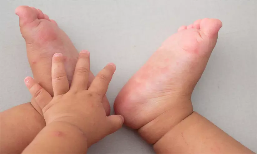 Hand foot Mouth Disease