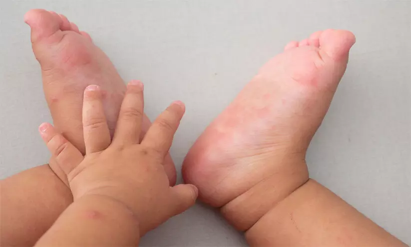 Hand foot Mouth Disease Hand foot Mouth Disease