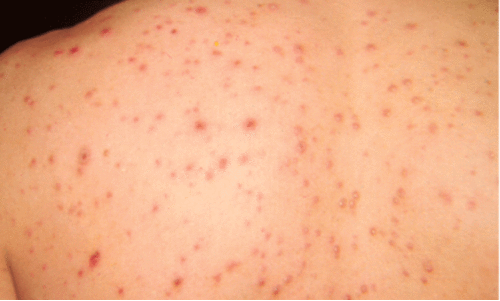 തക്കാളിപ്പനി പടരുന്നു; കഴിഞ്ഞ മാസം 60 കേസുകൾ