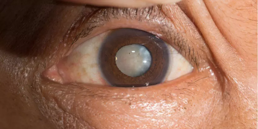 cataract surgery cataract surgery