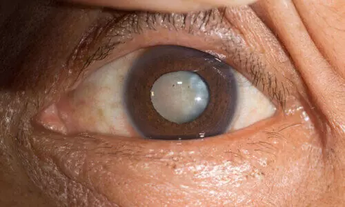 cataract surgery