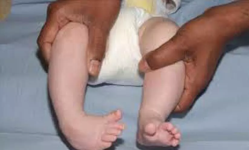 Clubfoot Clubfoot
