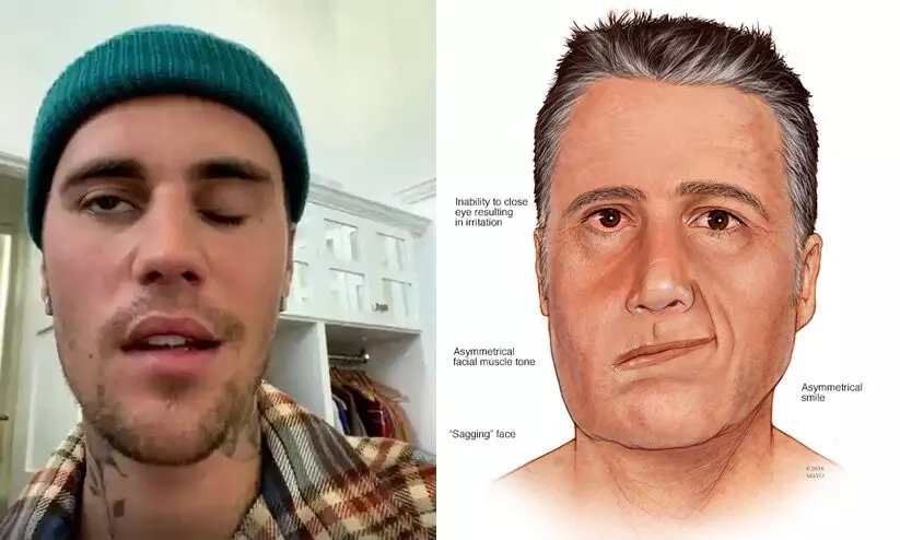 Ramsay Hunt syndrome Ramsay Hunt syndrome