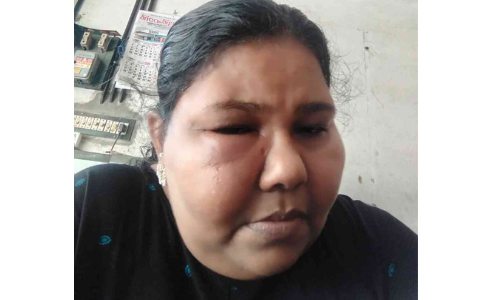 കോവിഡ് വാക്സിനെടുത്ത വീട്ടമ്മയുടെ ജീവിതം വഴിമുട്ടി