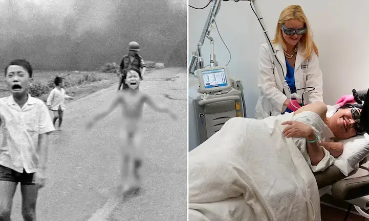 യുദ്ധത്തിന്‍റെ അവസാന മുറിപ്പാടും നീക്കം ചെയ്ത് നപാം പെൺകുട്ടി