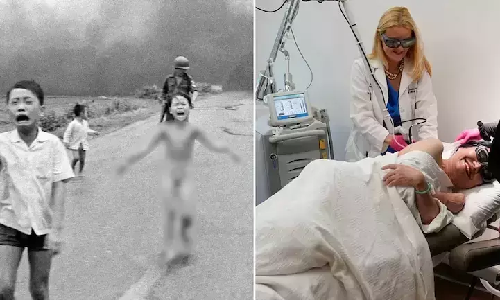 യുദ്ധത്തിന്‍റെ അവസാന മുറിപ്പാടും നീക്കം ചെയ്ത് നപാം പെൺകുട്ടി