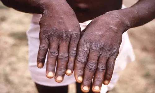 കന്നുകാലികളില്‍ കുരങ്ങുപനി: സംശയം തോന്നിയാല്‍ അറിയിക്കണം