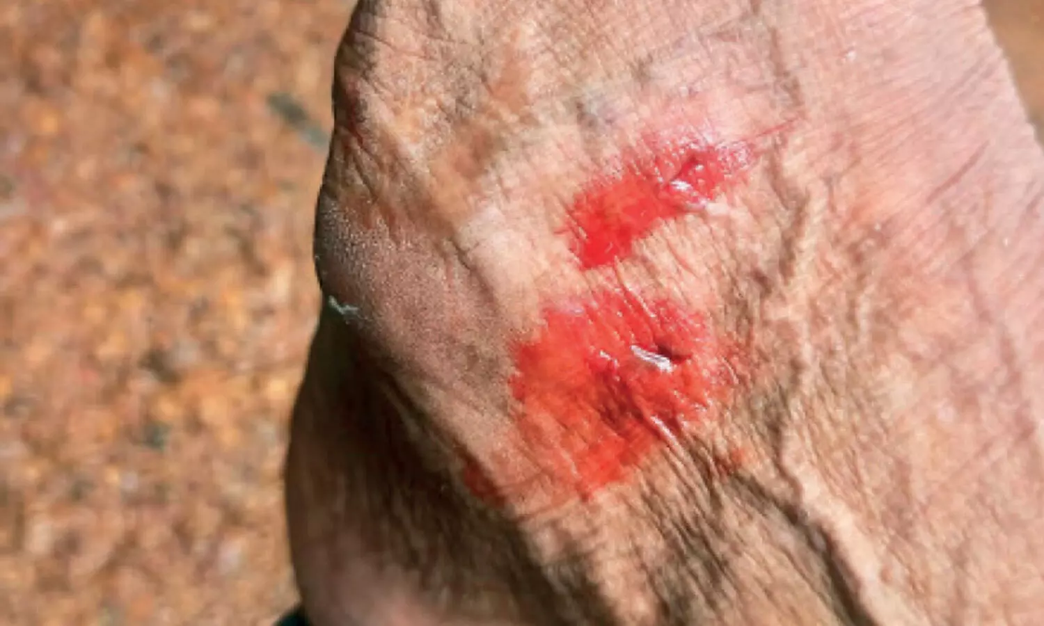 ചാലിയാറിൽ നീർനായ് ആക്രമണം രൂക്ഷം