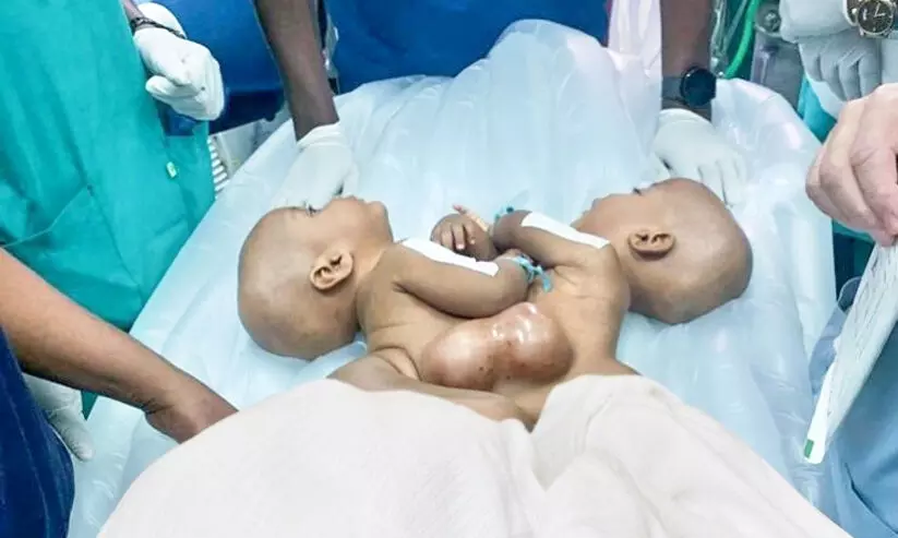 സയാമീസ് ഇരട്ടകൾക്ക് പുതുജീവൻ നൽകി കെ.എച്ച്.യു.എച്ച് ഡോക്ടർമാർ സയാമീസ് ഇരട്ടകൾക്ക് പുതുജീവൻ നൽകി കെ.എച്ച്.യു.എച്ച് ഡോക്ടർമാർ