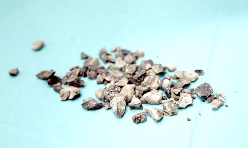 പ്രവാസിയുടെ വൃക്കയിൽനിന്ന്​ നീക്കംചെയ്തത്​ 200 കല്ലുകൾ