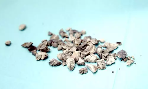 പ്രവാസിയുടെ വൃക്കയിൽനിന്ന്​ നീക്കംചെയ്തത്​ 200 കല്ലുകൾ