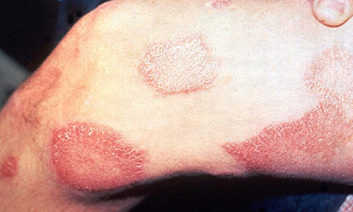 കോട്ടയത്ത് അഞ്ചുപേർക്കുകൂടി കുഷ്​ഠം; സ്ത്രീ​യും എ​ട്ടു​വ​യ​സ്സു​ള്ള ആ​ൺ​കു​ട്ടി​യു​മ​ട​ക്കം   13 പേർ​ ചി​കി​ത്സ​യി​ൽ