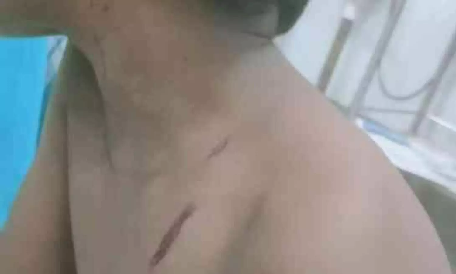 മൂന്നുവയസുകാരനെ തെരുവ് നായ കടിച്ചു; സംഭവം വീടിന് മുന്നിലിരുന്ന് കളിക്കവേ