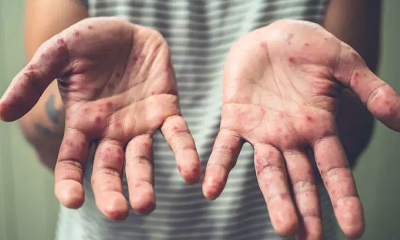 tomato flu 7687 tomato flu 7687