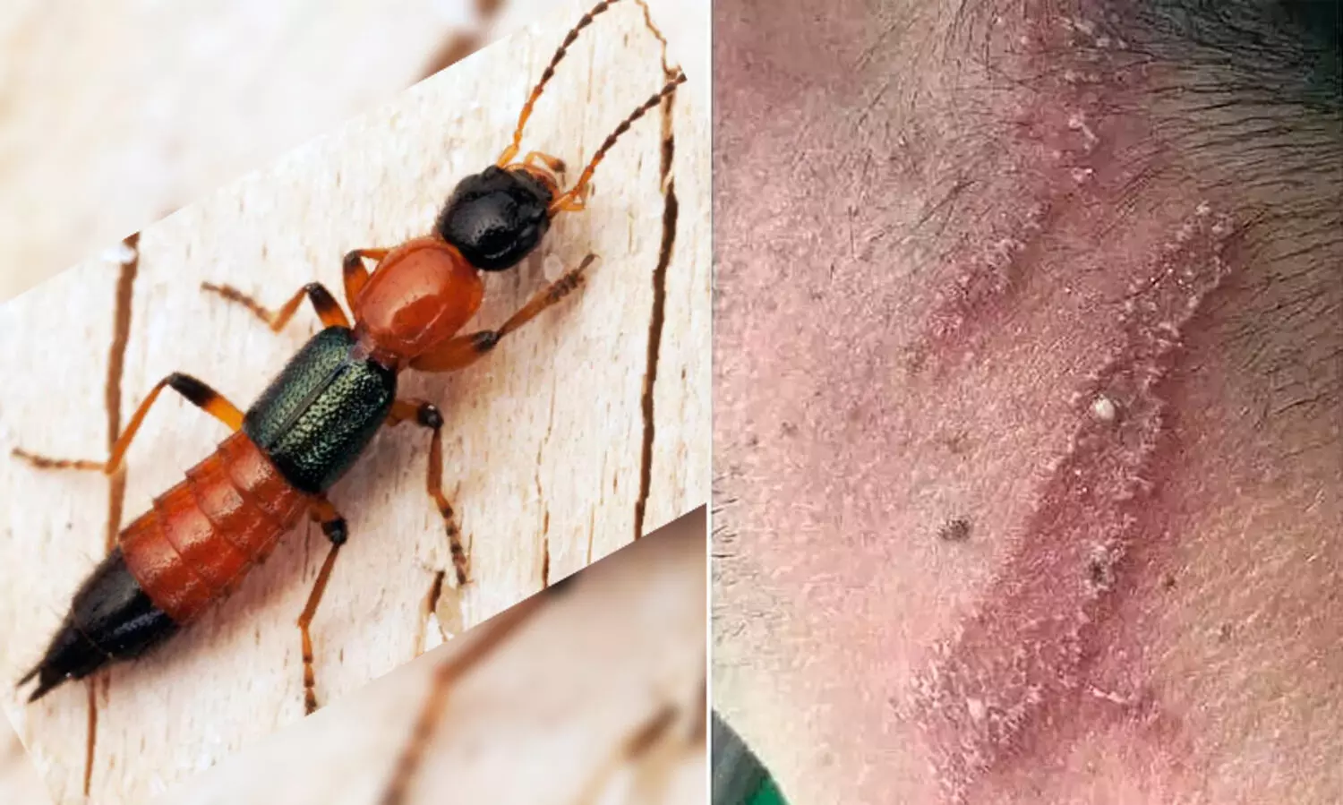 ശരീരത്തിൽ കയറിയാൽ പൊള്ളലേറ്റ പാട്; നൈറോബി ഈച്ച ആക്രമണത്തെക്കുറിച്ച് മുന്നറിയിപ്പ്