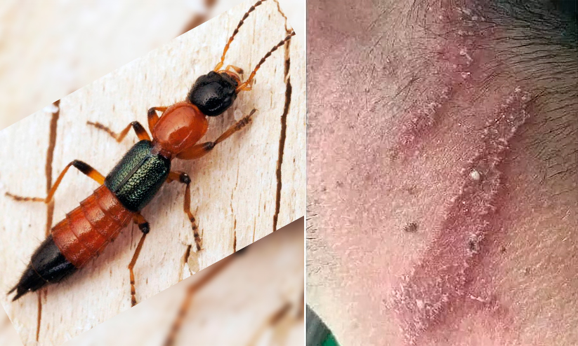 ശരീരത്തിൽ കയറിയാൽ പൊള്ളലേറ്റ പാട്; നൈറോബി ഈച്ച ആക്രമണത്തെക്കുറിച്ച് മുന്നറിയിപ്പ് ശരീരത്തിൽ കയറിയാൽ പൊള്ളലേറ്റ പാട്; നൈറോബി ഈച്ച ആക്രമണത്തെക്കുറിച്ച് മുന്നറിയിപ്പ്