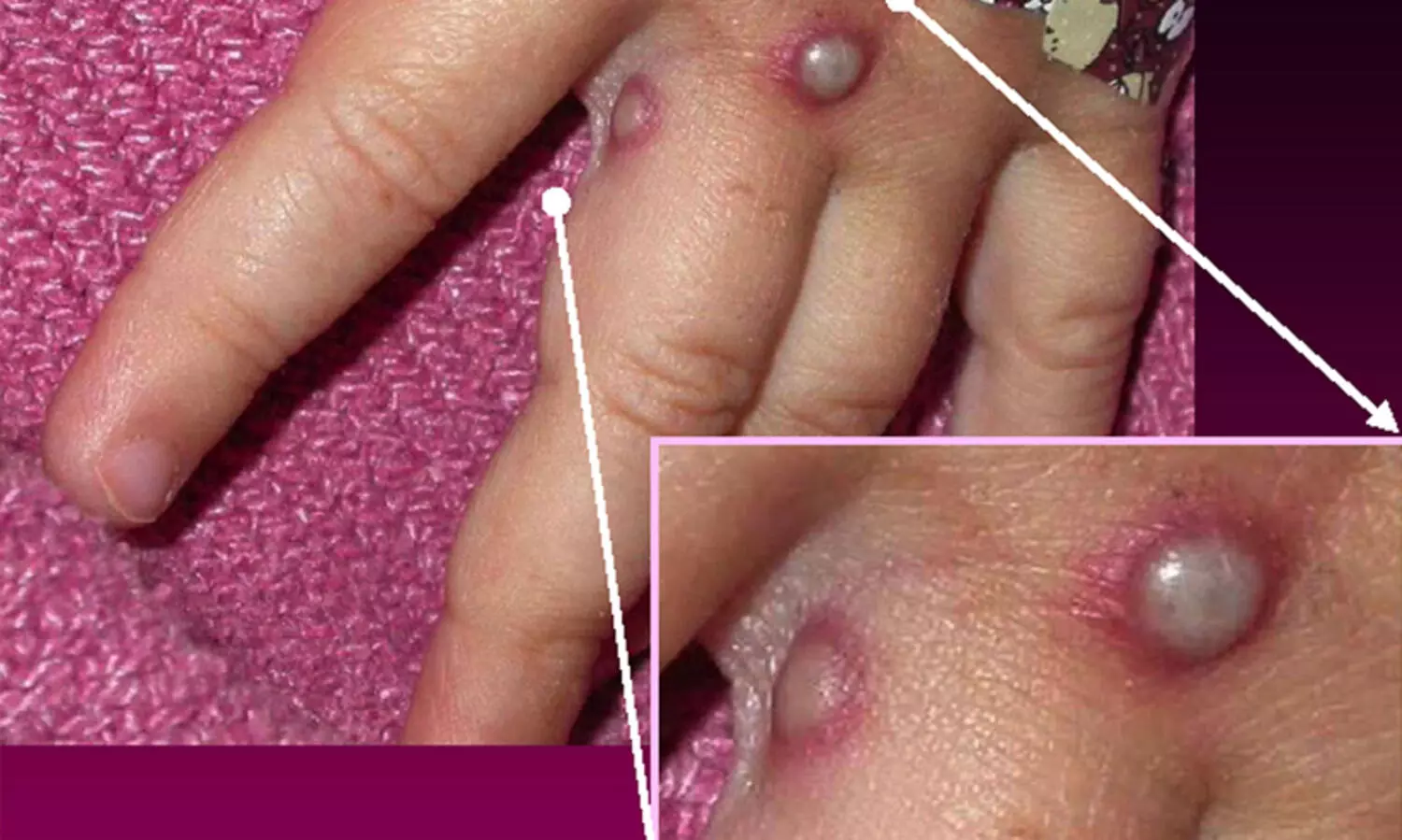 കുരങ്ങുവസൂരി: യു.എ.ഇയുടെ അനുഭവം സാക്ഷി, ആശങ്ക വേണ്ട!; മേയിൽ ആദ്യ കേസുണ്ടായിട്ടും ഗുരുതര സാഹചര്യമില്ല