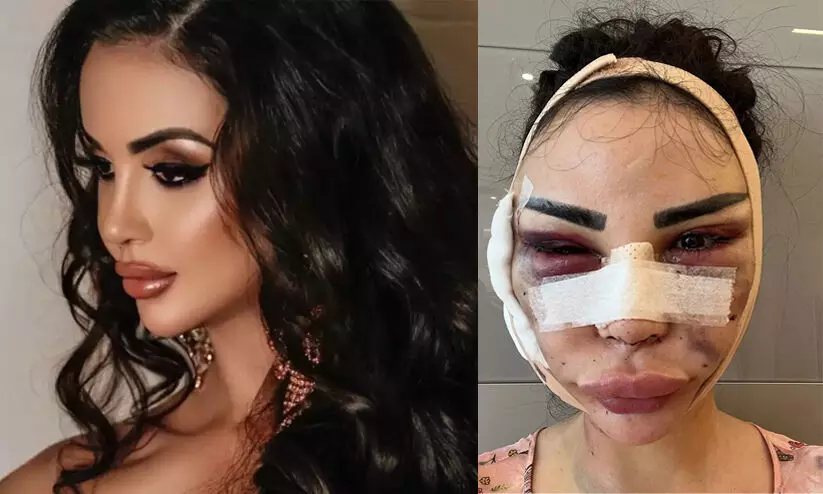 കിം കർദാഷിയാനെപ്പോലെയാകാൻ 4.78 കോടി മുടക്കിയ മോഡൽ യഥാർഥ രൂപത്തിലേക്ക് മടങ്ങാൻ ചെലവിടുന്നത് 95 ലക്ഷം