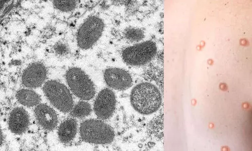 വാനര വസൂരി​: സമ്പര്‍ക്കത്തിലുള്ള രണ്ട്​ ഓട്ടോ ഡ്രൈവർമാരെ കണ്ടെത്തി