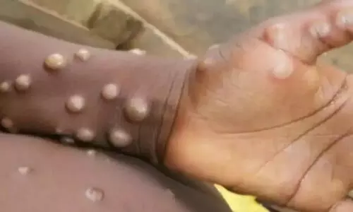 മങ്കി പോക്സ് : ലക്ഷണങ്ങളെന്തെല്ലാം, പകരുന്നതെങ്ങനെ?