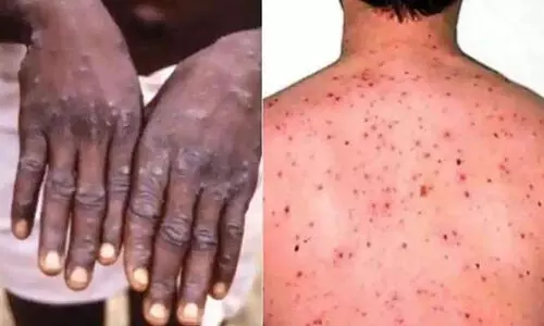 വാനര വസൂരി: ചിക്കൻ പോക്സ്​ സമാന ലക്ഷണങ്ങളുള്ളവരെ നിരീക്ഷിക്കും